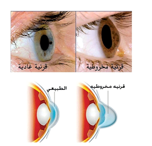 القرنية المخروطية